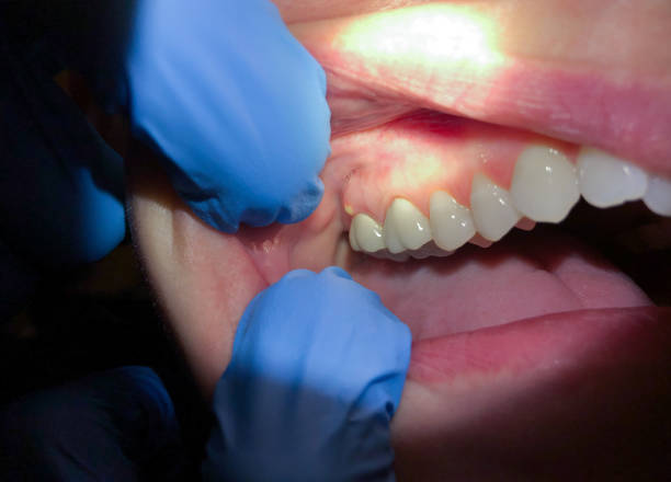 Best Emergency Wisdom Teeth Removal in Owensville, IN