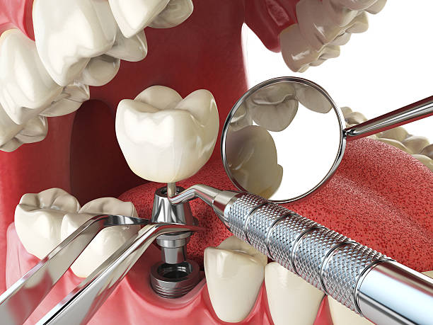 Best Emergency Wisdom Teeth Removal in Owensville, IN